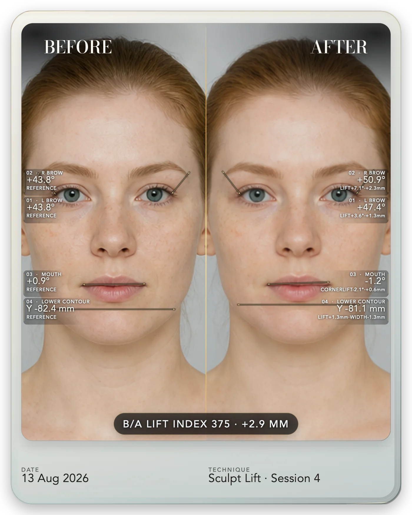 A B/A Studio comparison with anatomical guides and a measured lift of 2.9 millimetres